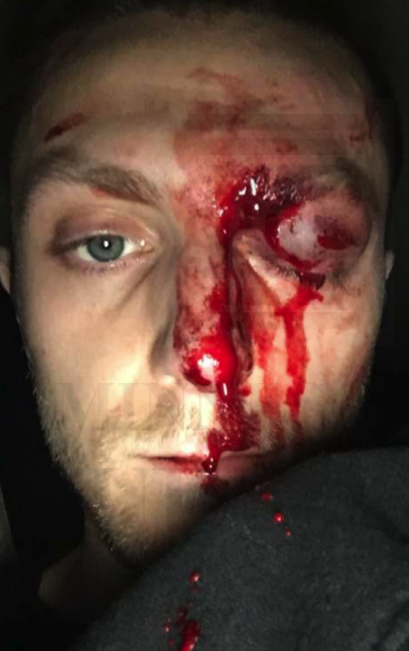 Minnesota cop injured man’s eye with riot munition, lawsuit says